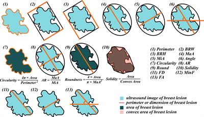 Development and External Validation of a Simple-To-Use Dynamic Nomogram for Predicting Breast Malignancy Based on Ultrasound Morphometric Features: A Retrospective Multicenter Study